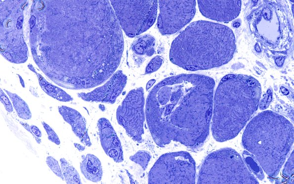 2L9Atrophy, Perifascicular (Case 2) Plastic 100X 5