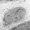 2M4A Dermatomyositis (Case 2) EM 042 - Copy