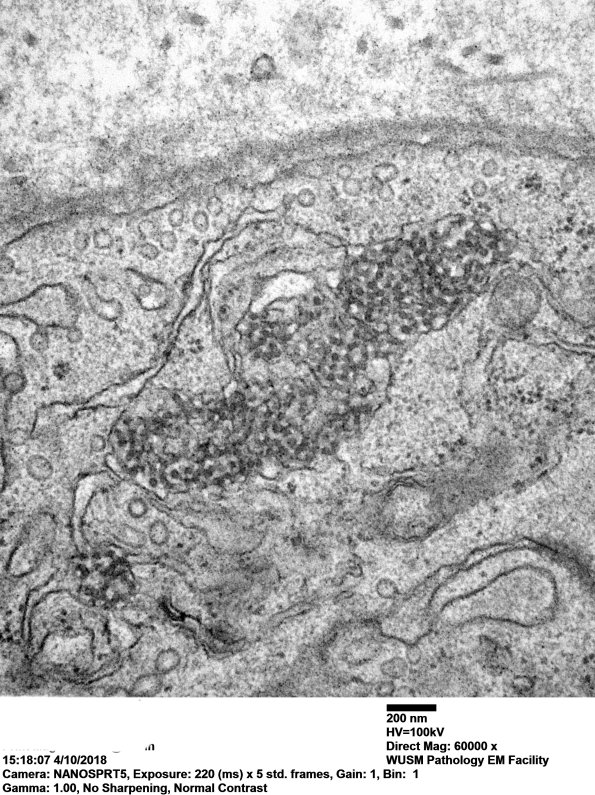 2M4C Dermatomyositis, (Case 2) EM 044 - Copy