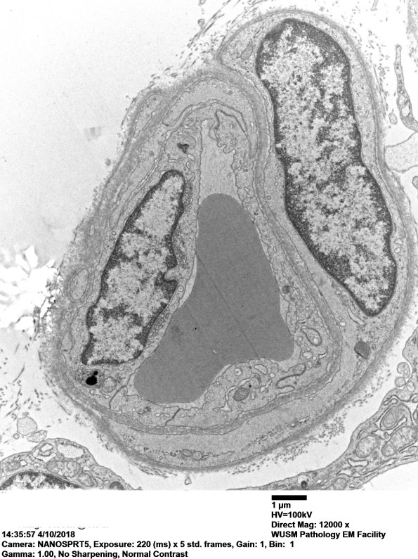2M5A Dermatomyositis, (Case 2) EM 028 - Copy