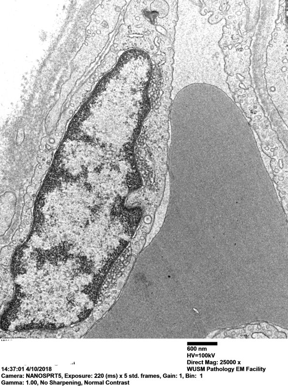 2M5B Dermatomyositis, (Case 2) EM 029 - Copy