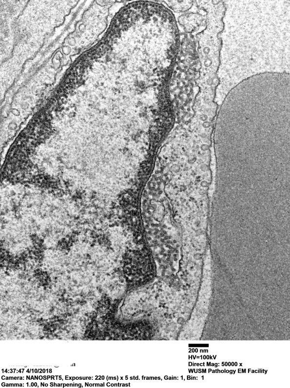 2M5C Dermatomyositis, (Case 2) EM 030 - Copy