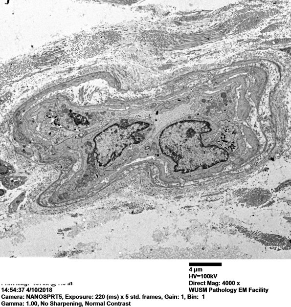 2M6A Dermatomyositis, (Case 2) EM 031 - Copy