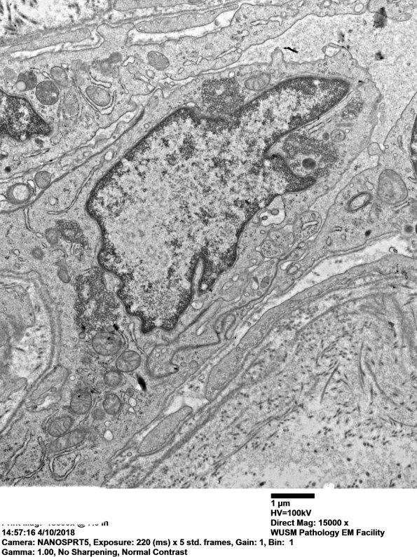 2M6B Dermatomyositis, (Case 2) EM 033 - Copy