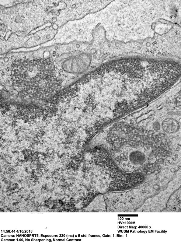 2M6DDermatomyositis, (Case 2) EM 035 - Copy
