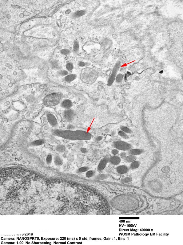 2M7A Dermatomyositis, (Case 2) EM 036 copy - Copy