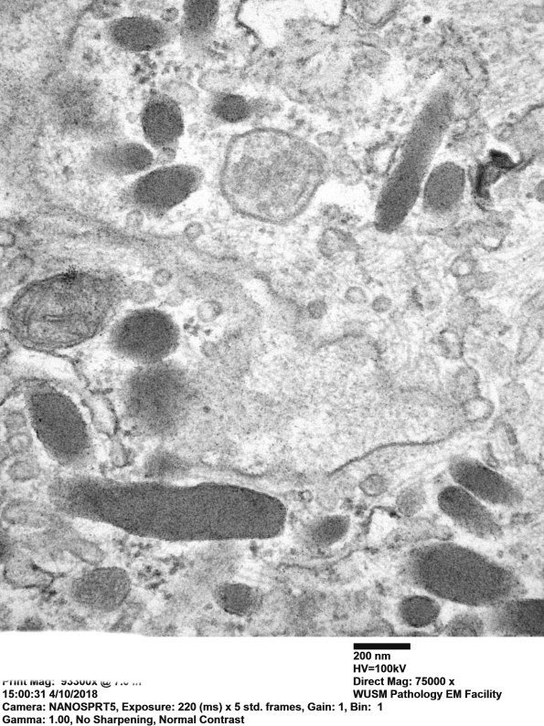 2M7B (Case 2 EM 037 - Copy - Copy