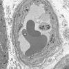 2M8A Dermatomyositis (Case 2) EM 045 - Copy