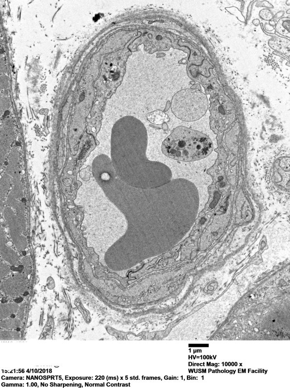 2M8A Dermatomyositis (Case 2) EM 045 - Copy