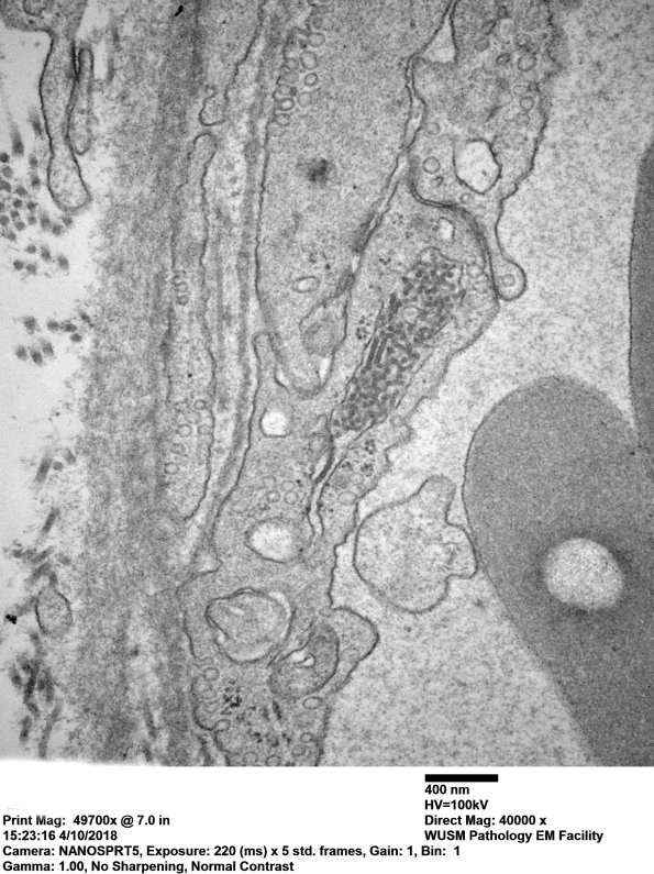 2M8B Dermatomyositis, (Case 2) EM 047 - Copy