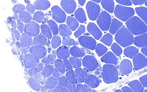 2l6 Atrophy, Perifascicular (Case 2) Plastic 40X