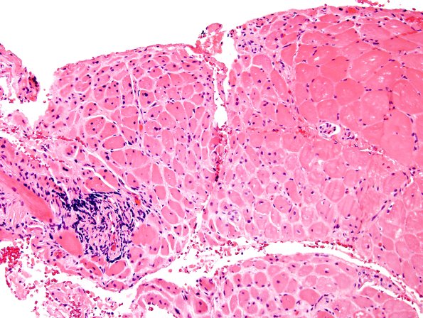 3A3 Dermatomyositis (Case 3) H&E 7