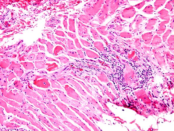 3A4 Dermatomyositis (Case 3) H&E 12