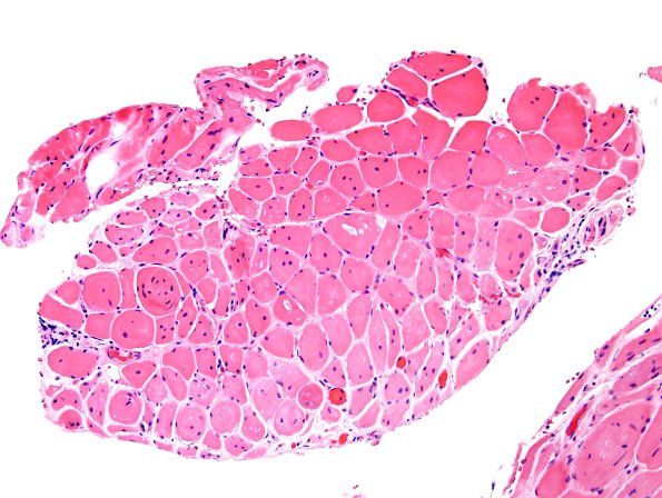 3A5 Dermatomyositis (Case 3) H&E 5