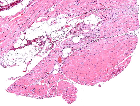 3A7A Dermatomyositis (Case 3) H&E 8