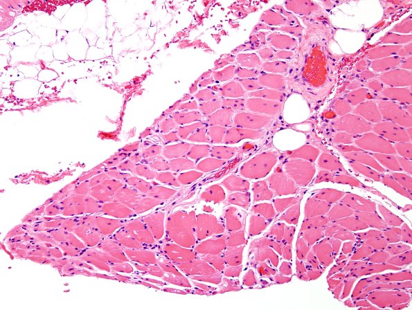 3A7B Dermatomyositis (Case 3) H&E 9