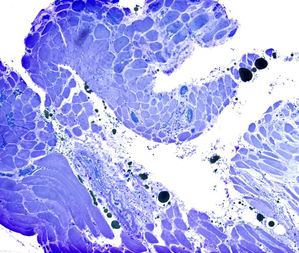 3B1 Dermatomyositis (Case 3) Plastic 6