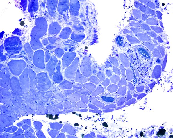 3B2 Dermatomyositis (Case 3) Plastic 7