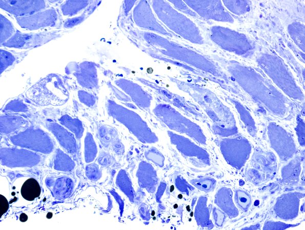 3B3 Dermatomyositis (Case 3) Plastic 8