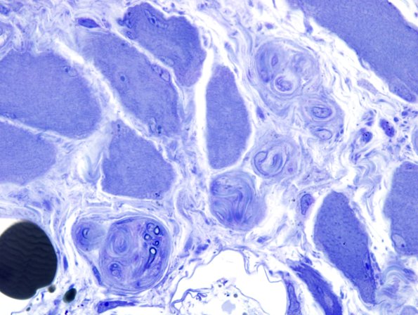 3B4 Dermatomyositis (Case 3) Plastic 4