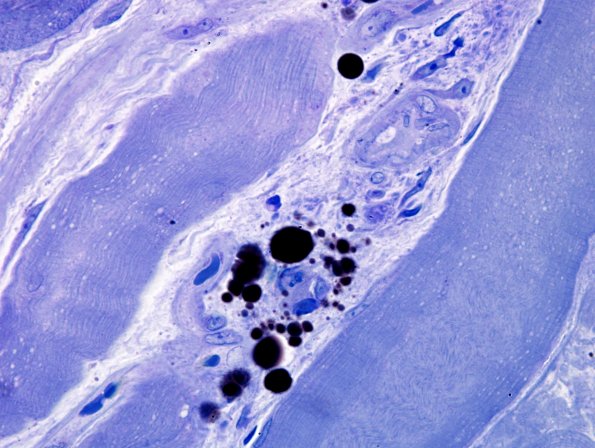 3B5A Dermatomyositis (Case 3) Plastic 1