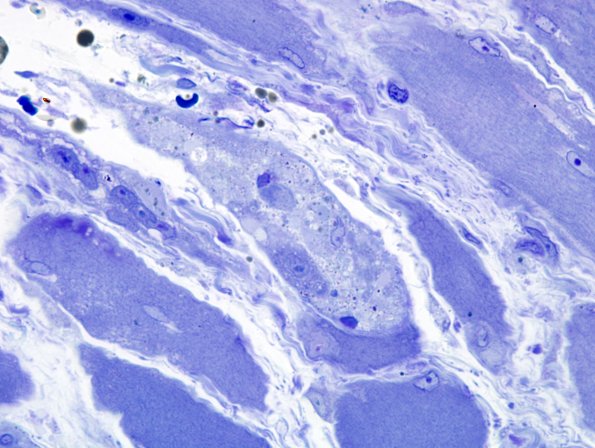 3B6 Dermatomyositis (Case 3) Plastic 3