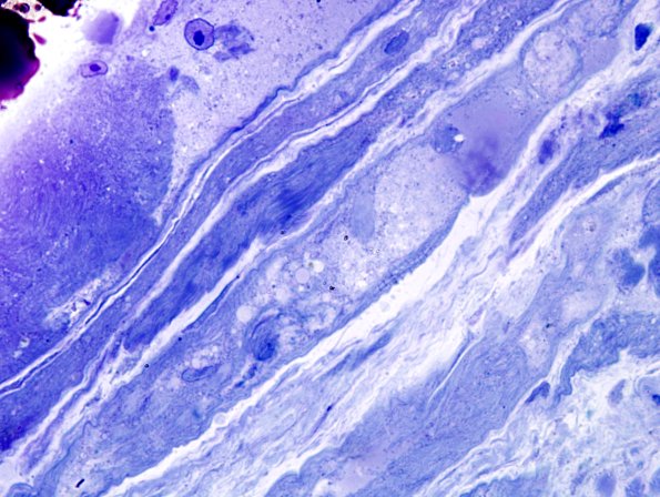 3B7 Dermatomyositis (Case 3) Plastic 5