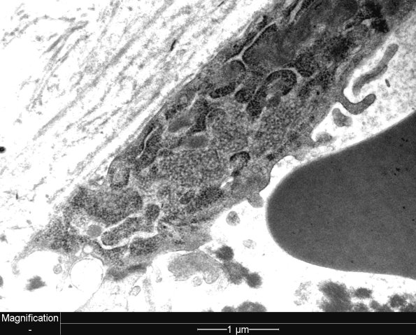 3C1A Dermatomyositis (Case 3) EM 2 - Copy