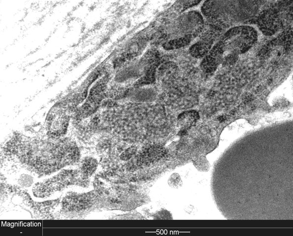 3C1B Dermatomyositis (Case 3) EM 1 - Copy