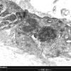 3C2 Dermatomyositis (Case 3) EM 4 - Copy