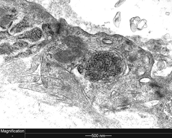 3C2 Dermatomyositis (Case 3) EM 4 - Copy