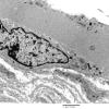 3C3A Inclusions, dermatomyositis (Case 3) 022A - Copy