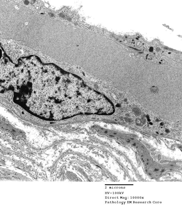 3C3A Inclusions, dermatomyositis (Case 3) 022A - Copy