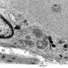 3C3B Inclusions, dermatomyositis (Case 3) 023A - Copy