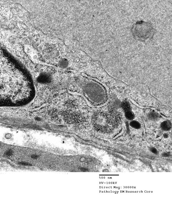 3C3B Inclusions, dermatomyositis (Case 3) 023A - Copy