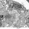 3C4A Inclusions, dermatomyositis (Case 3) 012A - Copy
