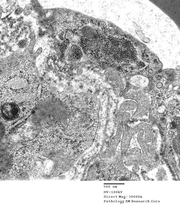 3C4A Inclusions, dermatomyositis (Case 3) 012A - Copy