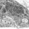 3C4B Inclusions,dermatomyositis (Case 3) 007A - Copy