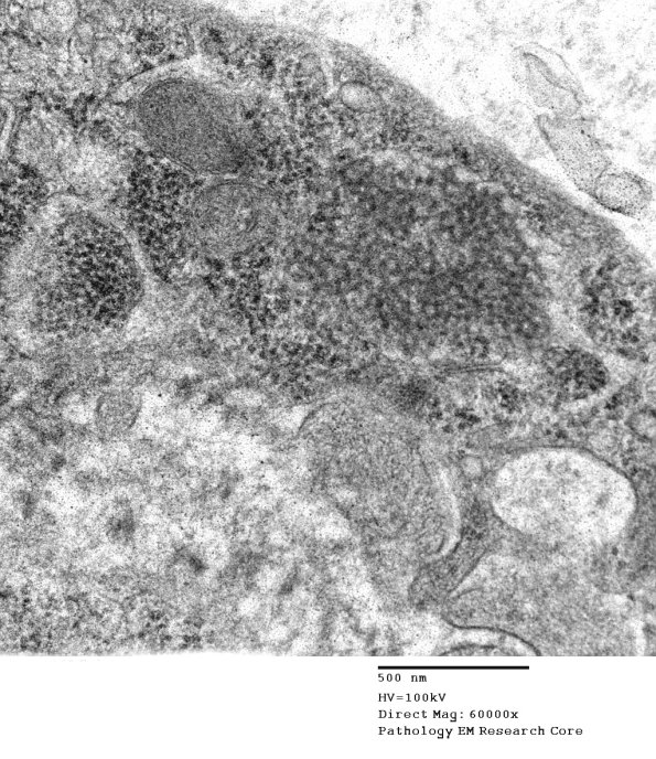 3C4B Inclusions,dermatomyositis (Case 3) 007A - Copy