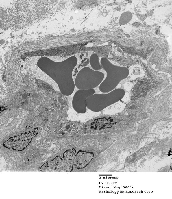 3C5A Inclusions, dermatomyositis (Case 3) 014A - Copy