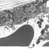 3C5B Inclusions, dermatomyositis (Case 3) 009A - Copy