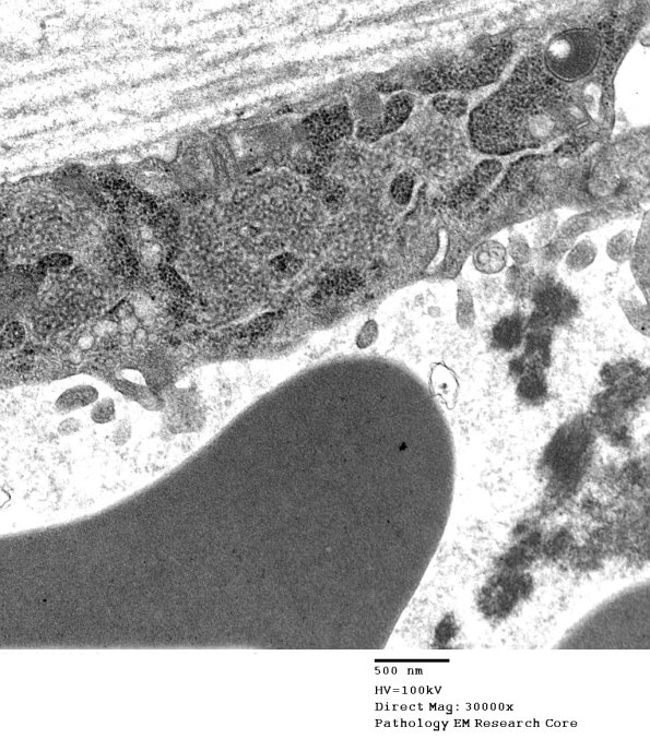 3C5B Inclusions, dermatomyositis (Case 3) 009A - Copy