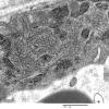 3C5C Inclusions, dermatomyositis (Case 3) 010A - Copy