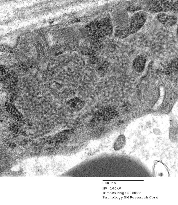 3C5C Inclusions, dermatomyositis (Case 3) 010A - Copy