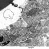 3C5D Inclusions, dermatomyositis (Case 3) 011A - Copy