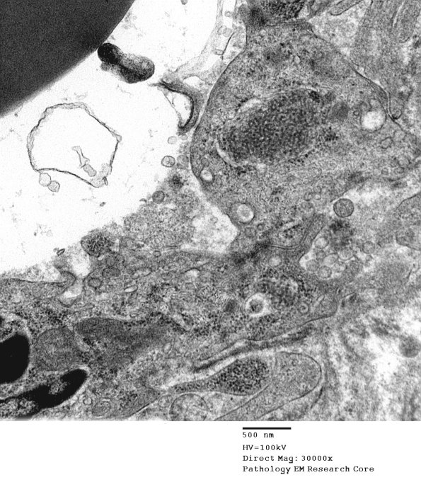 3C5D Inclusions, dermatomyositis (Case 3) 011A - Copy
