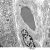 3C6A Inclusions, dermatomyositis (Case 3) 019A - Copy