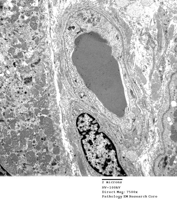 3C6A Inclusions, dermatomyositis (Case 3) 019A - Copy