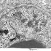 3C6B Inclusions, dermatomyositis (Case 3) 021A - Copy