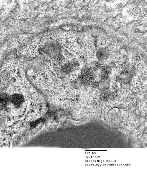 3C6B Inclusions, dermatomyositis (Case 3) 021A - Copy